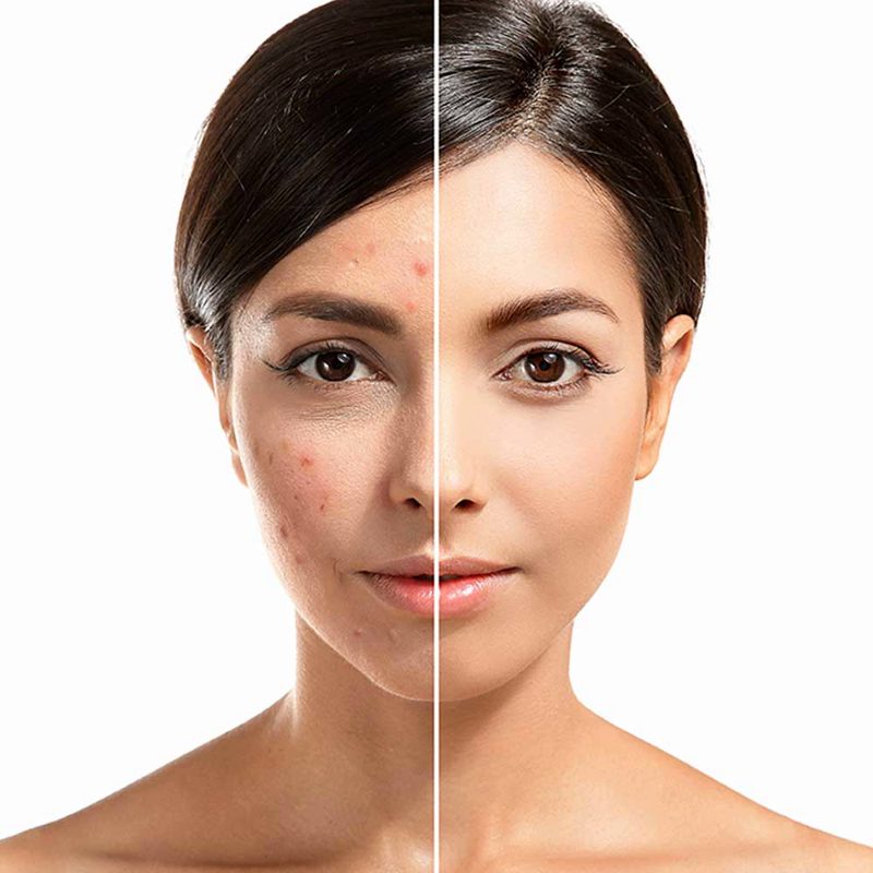 عکس قبل و بعد از فیشیال پوست